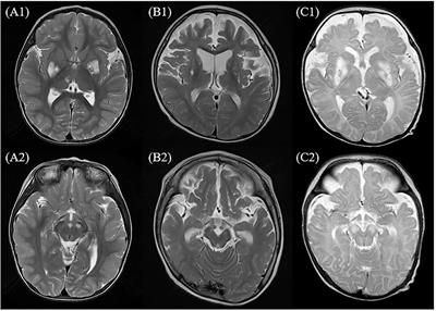 Association Between Epilepsy and Leigh Syndrome With MT-ND3 Mutation, Particularly the m.10191T>C Point Mutation